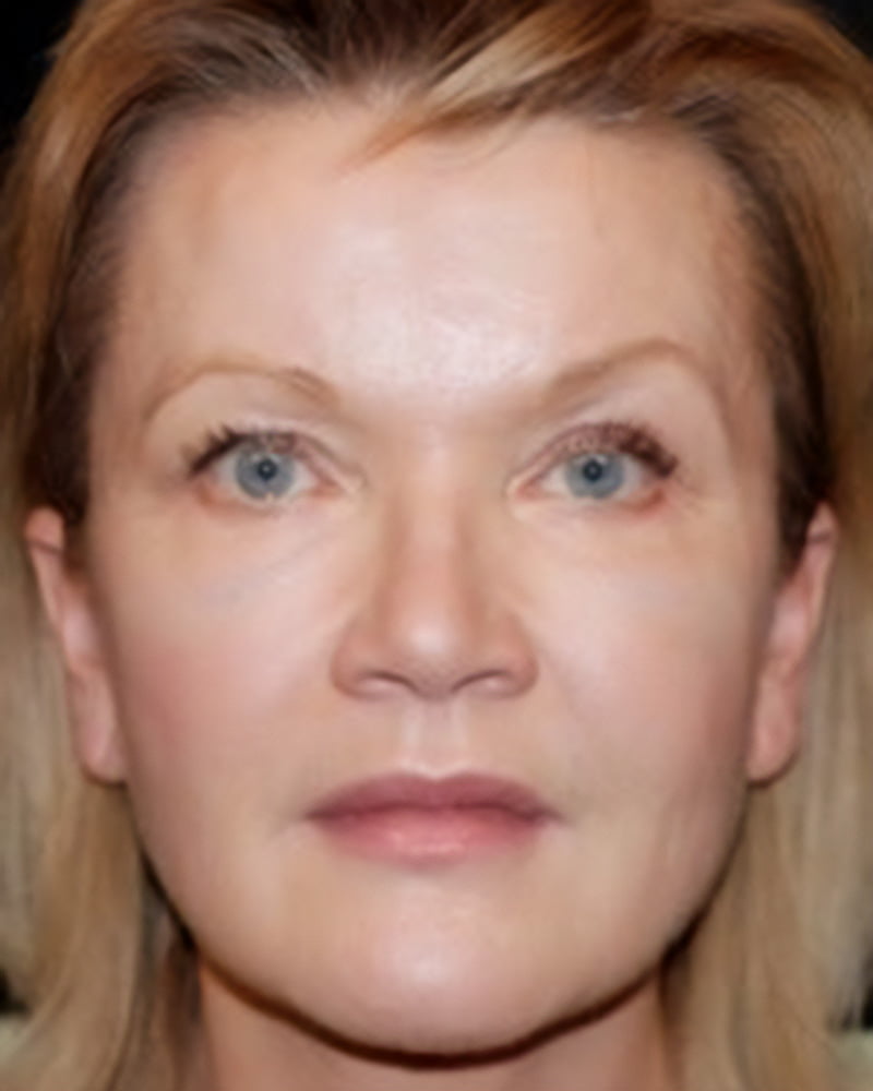 woman's face after filler treatment