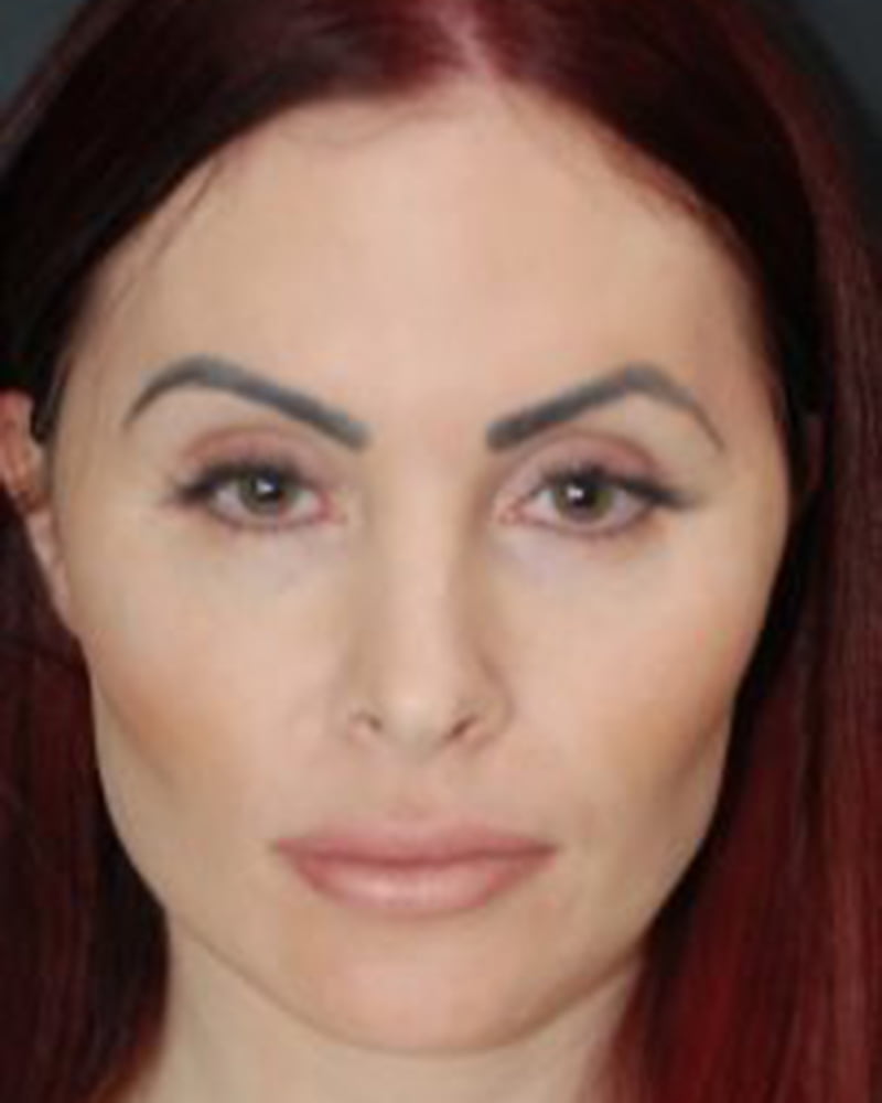 woman after dermal treatment