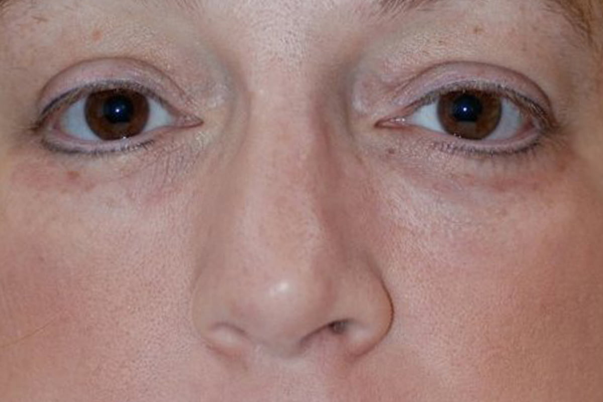 close up of woman's eyes after dermal treatment