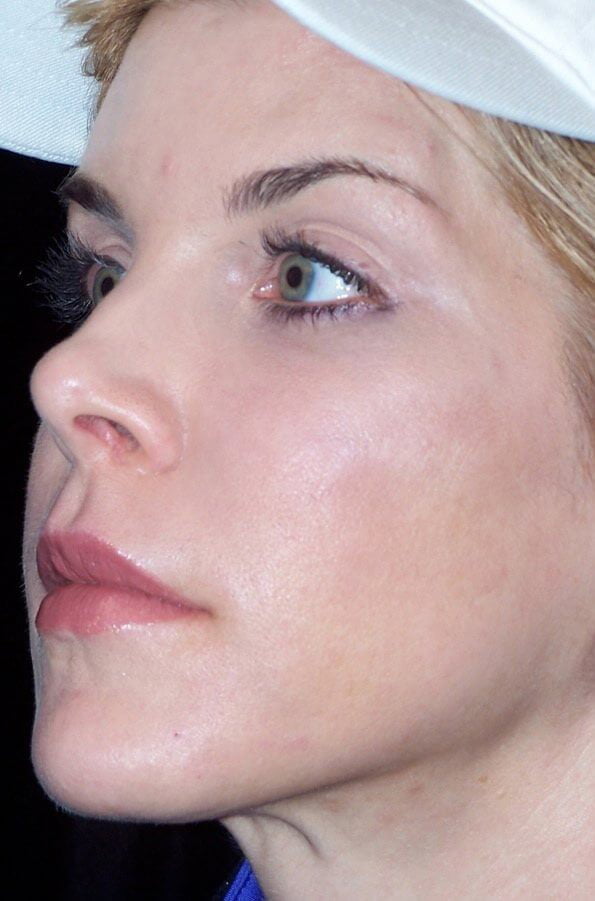 Woman's facial profile after laser treatment