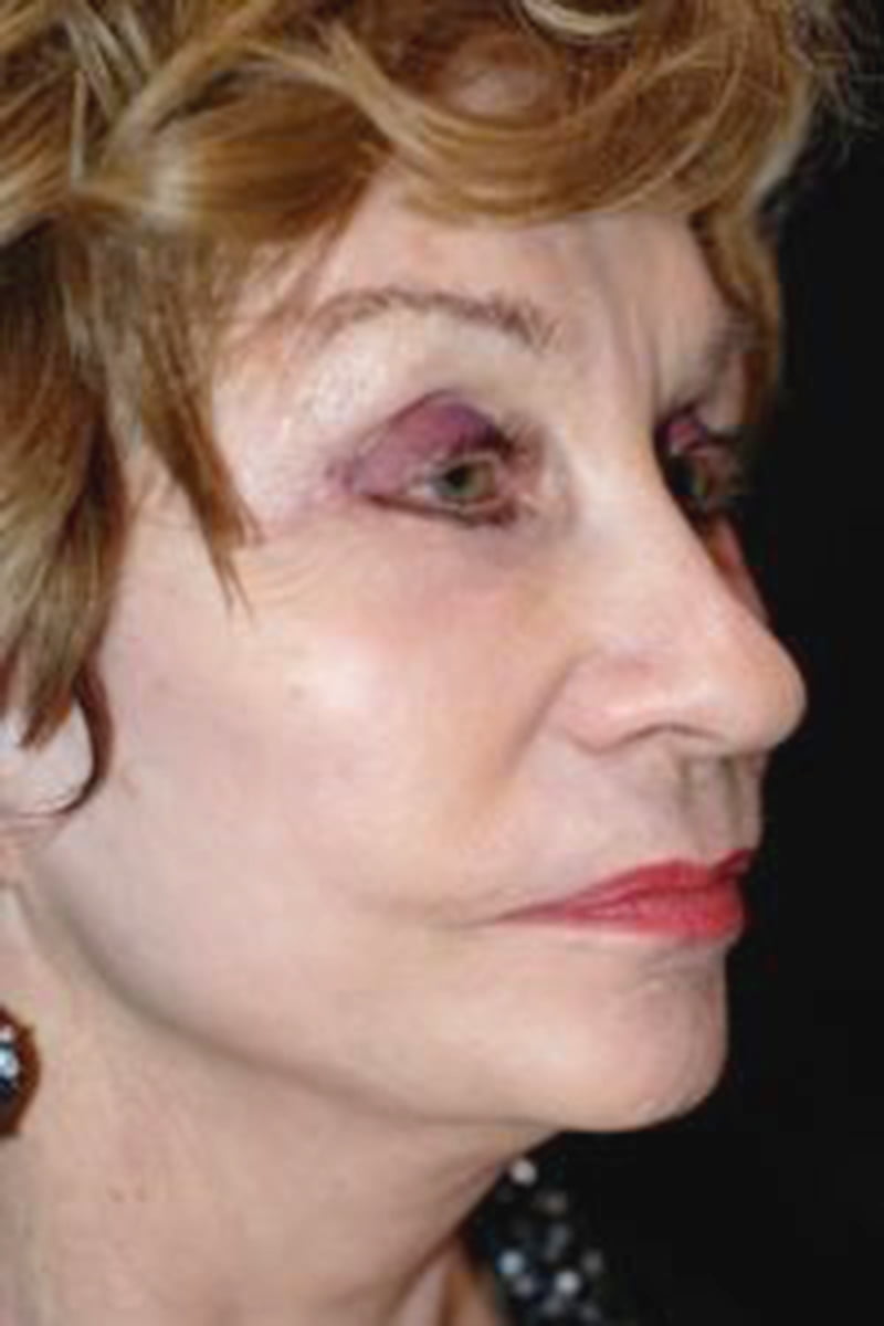 woman after dermal treatment