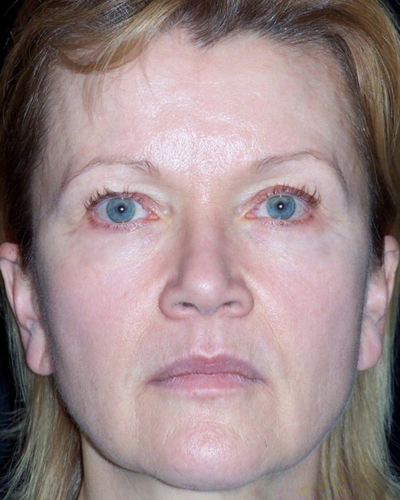 woman's face before treatment