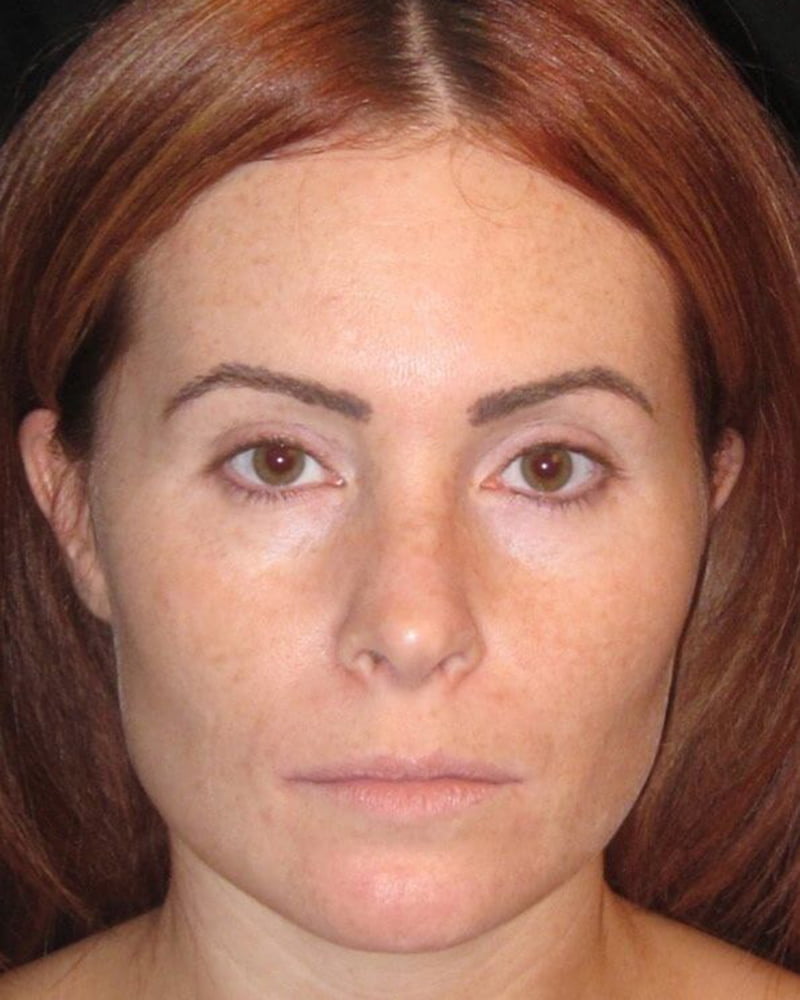 woman before dermal treatment