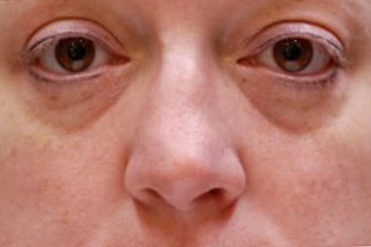 close up of woman's eyes before treatment