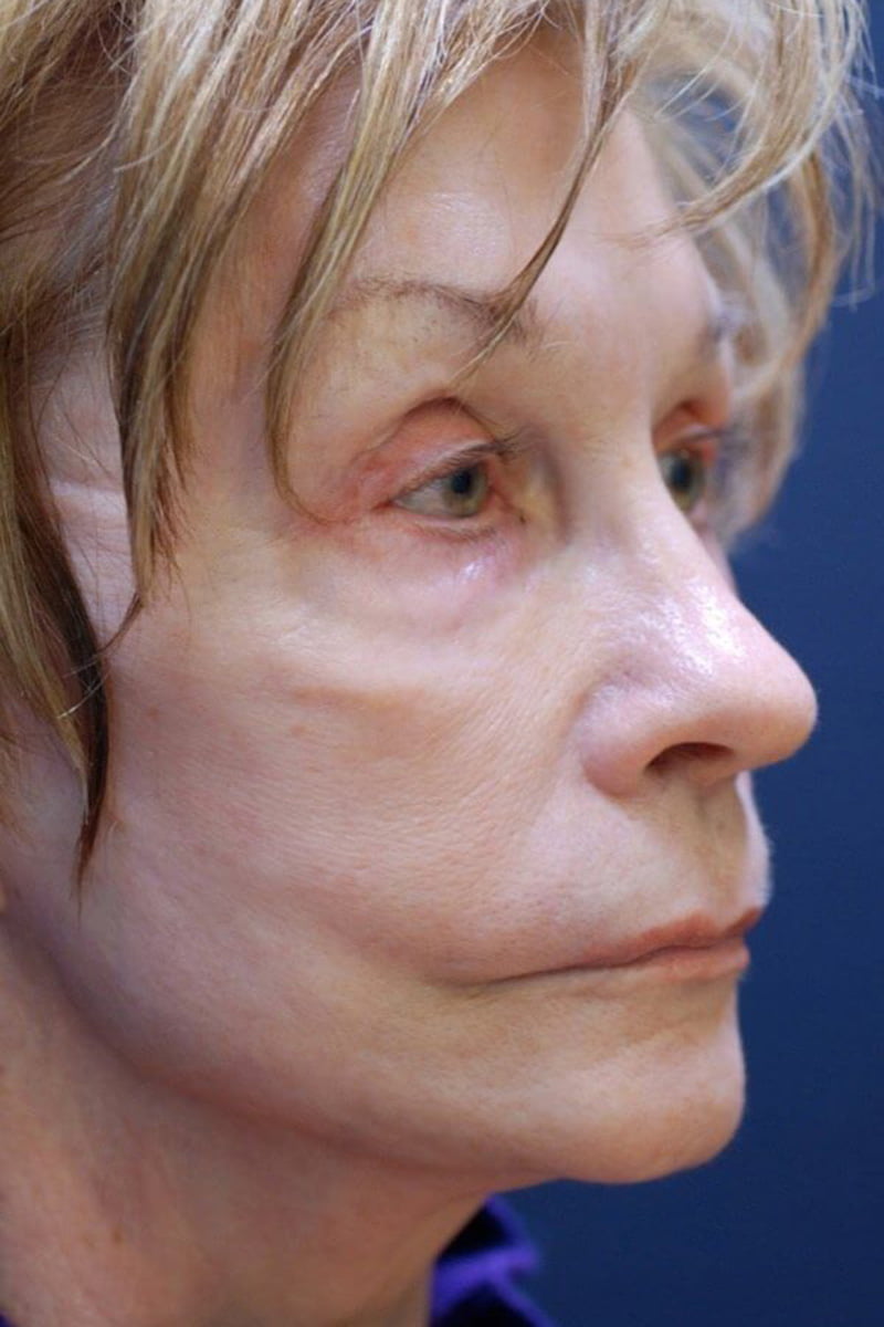 woman before dermal treatment