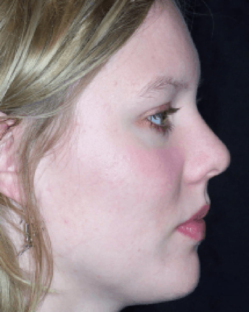 side of woman's face after acne laser treatment