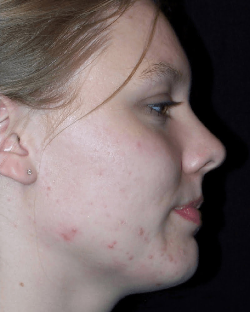 side of woman's face before acne laser treatment