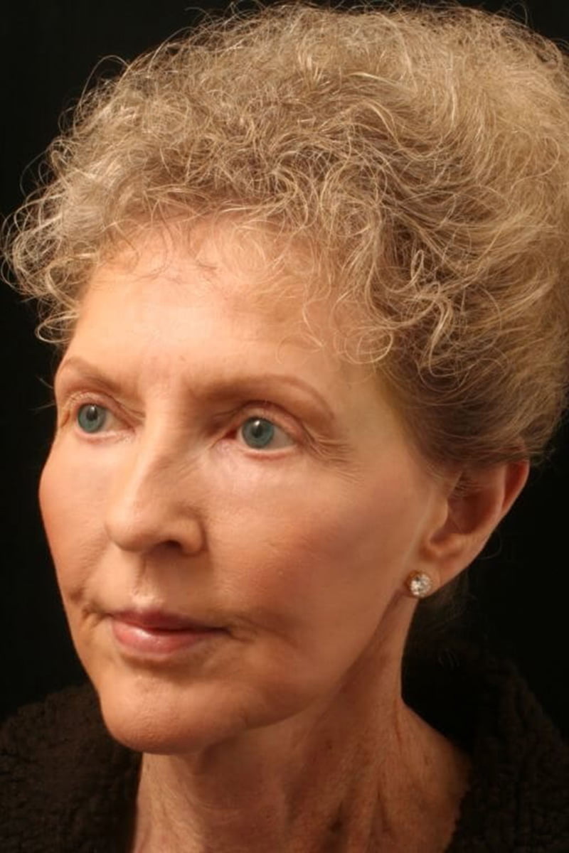 woman after filler treatment