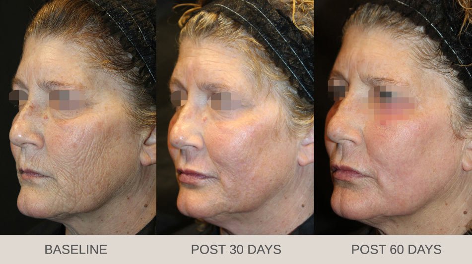 woman before and after laser skin treatment