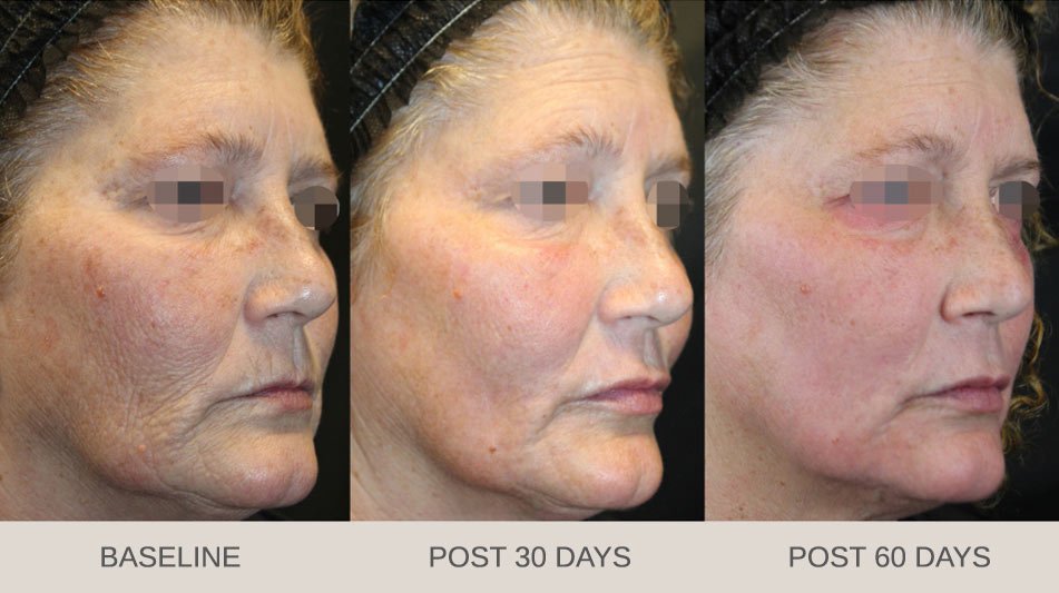 woman before and after laser skin treatment