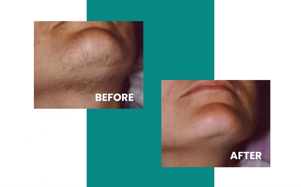 before and after chin laser hair removal