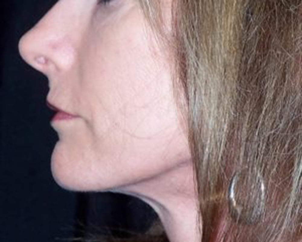 woman's mouth after sculptra filler treatment