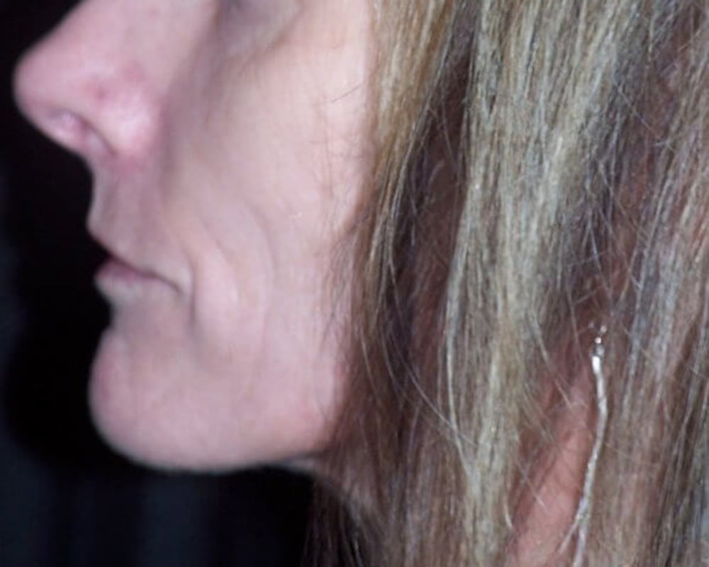 woman's mouth before treatment