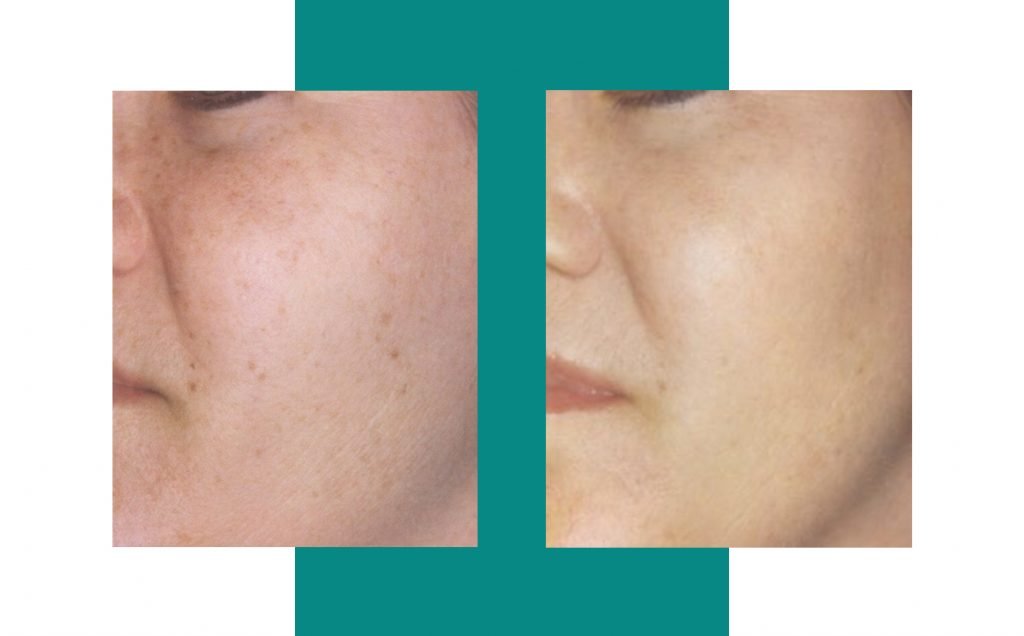 woman's face before and after laser treatment