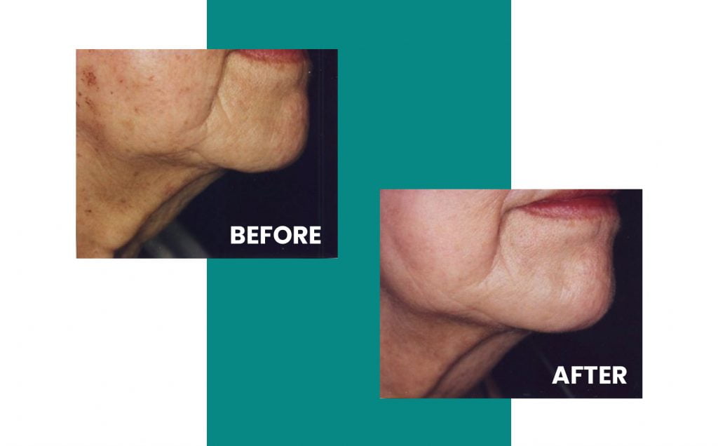 woman's chin before and after IPL laser treatmet