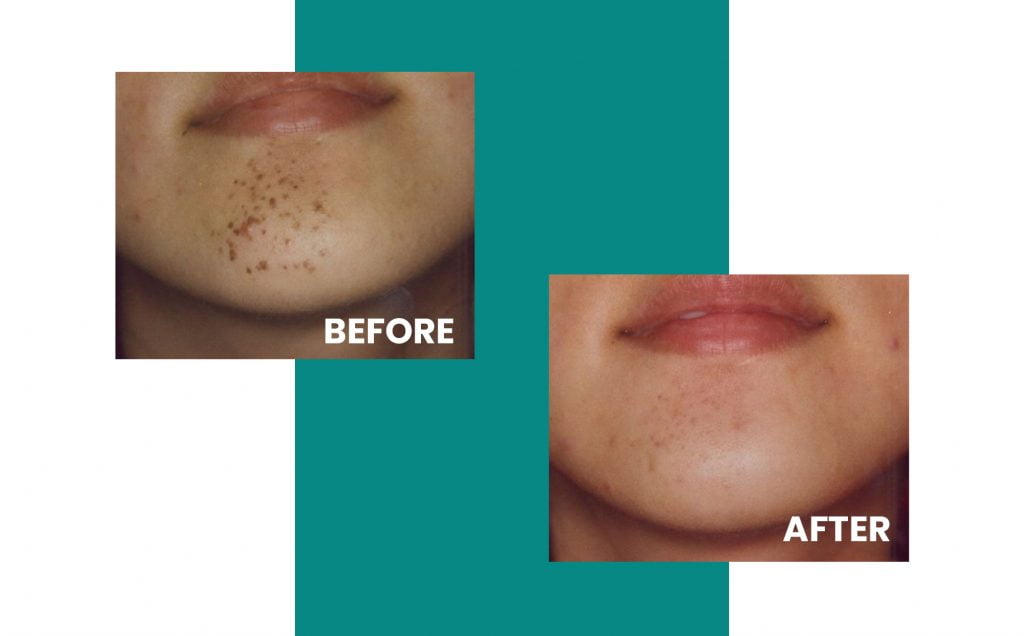 woman's chin before and after blemish removal treatment