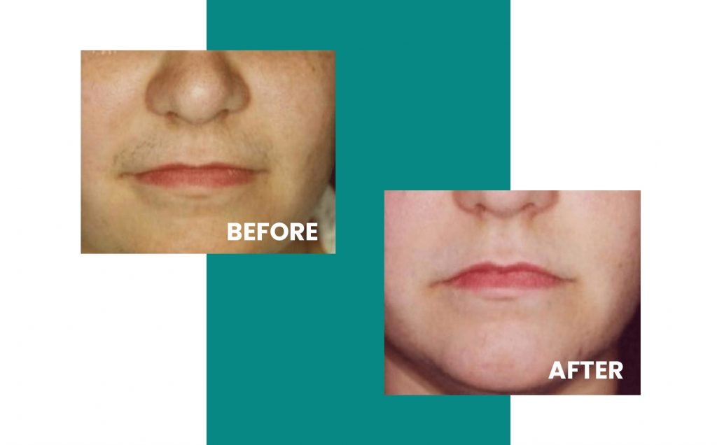 close up of face before and after laser hair removal