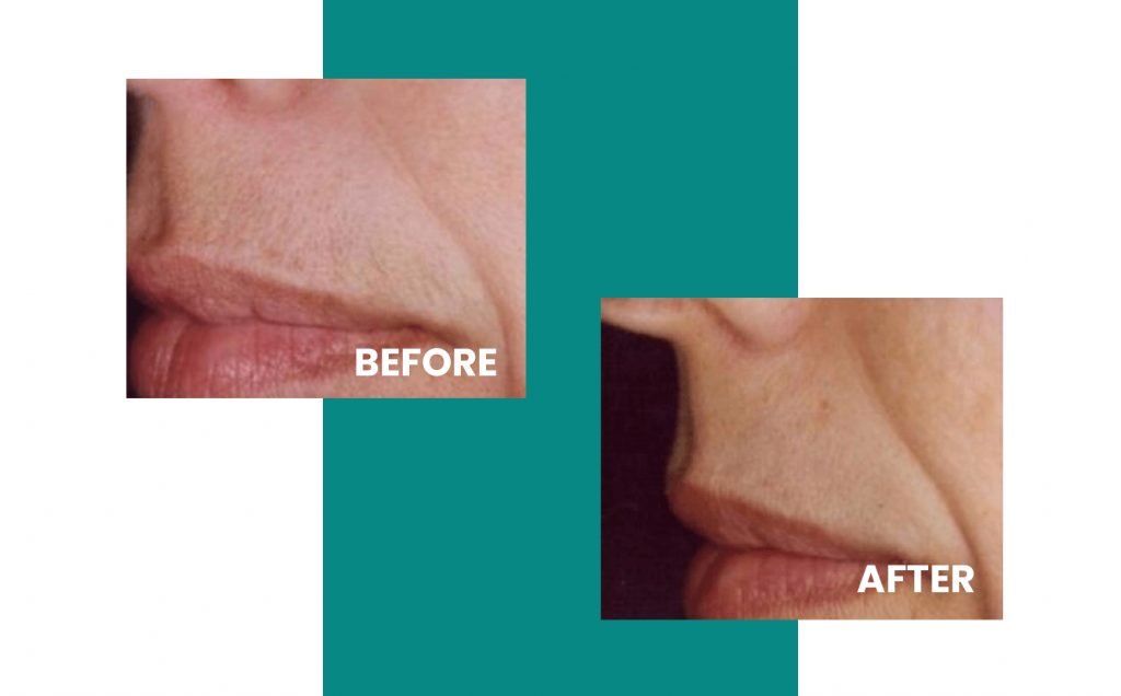 close up of lip before and after laser hair removal