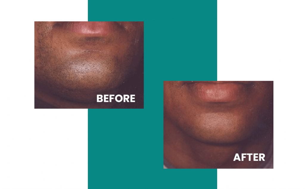 close up of chin before and after laser hair removal