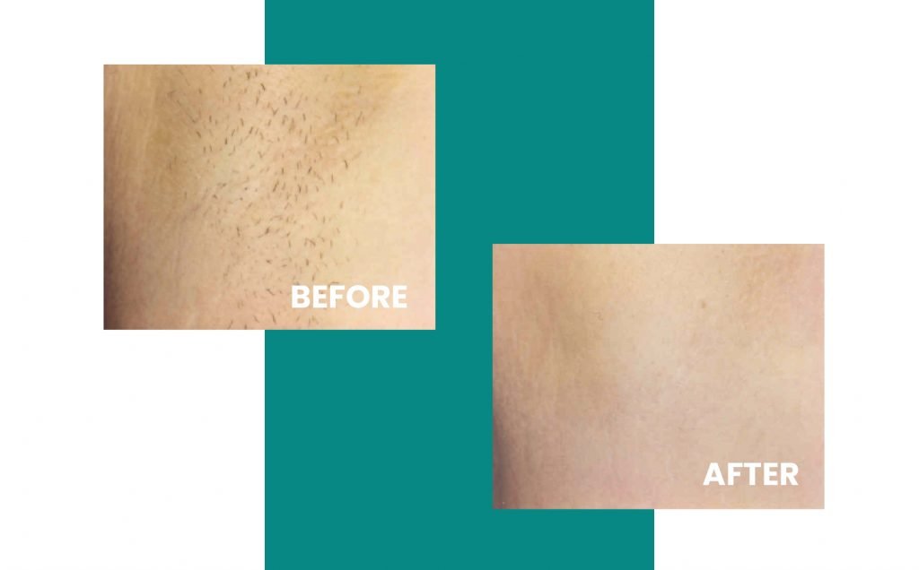 Close up before and after laser hair removal