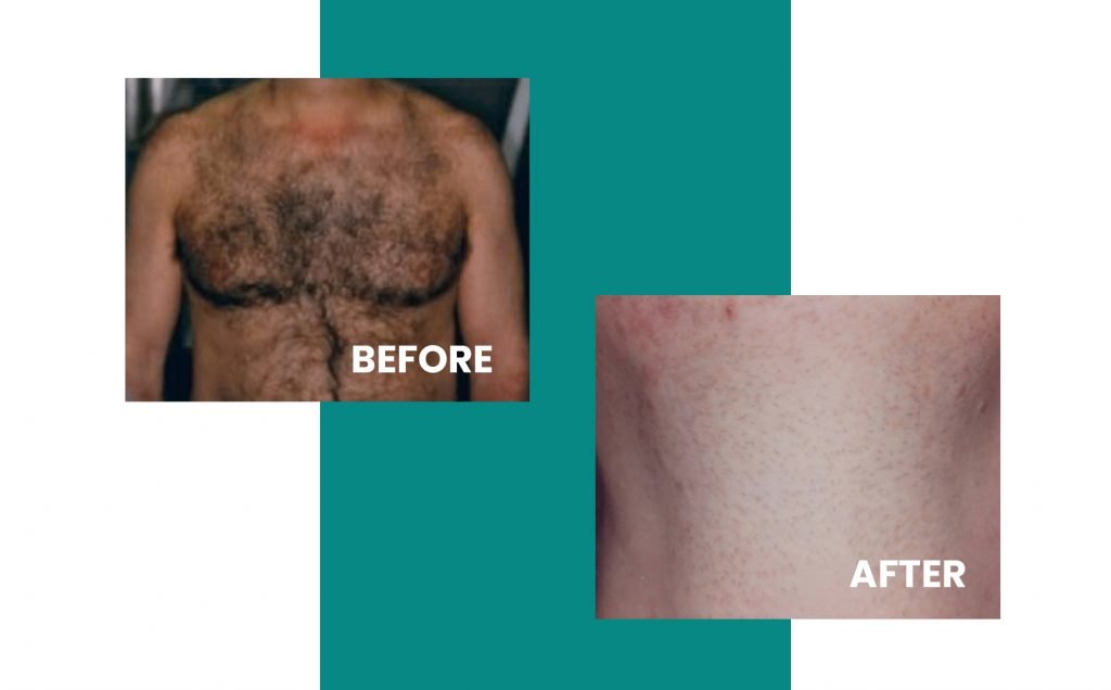 man's chest before and after laser hair removal