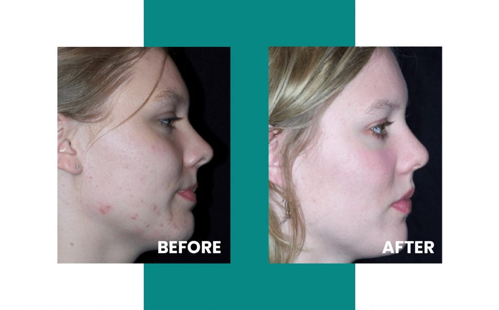 side of woman's face before and after acne laser treatment