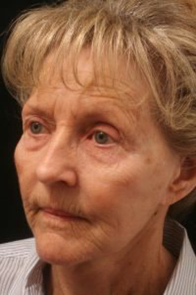 woman before treatment
