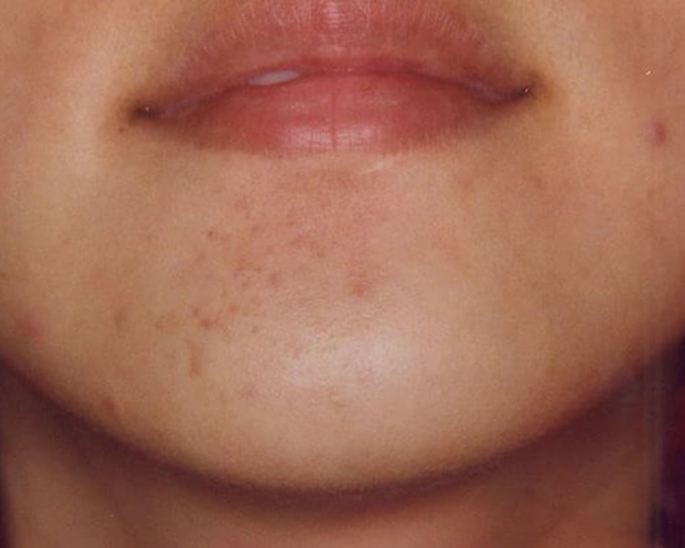 woman's chin after blemish removal