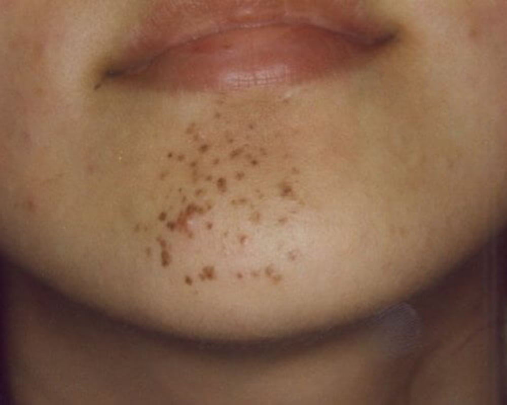 woman's chin before blemish removal