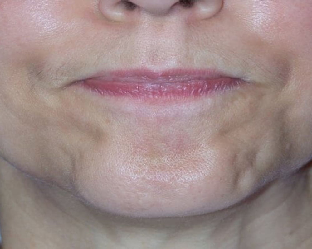 woman's face after botox treatment