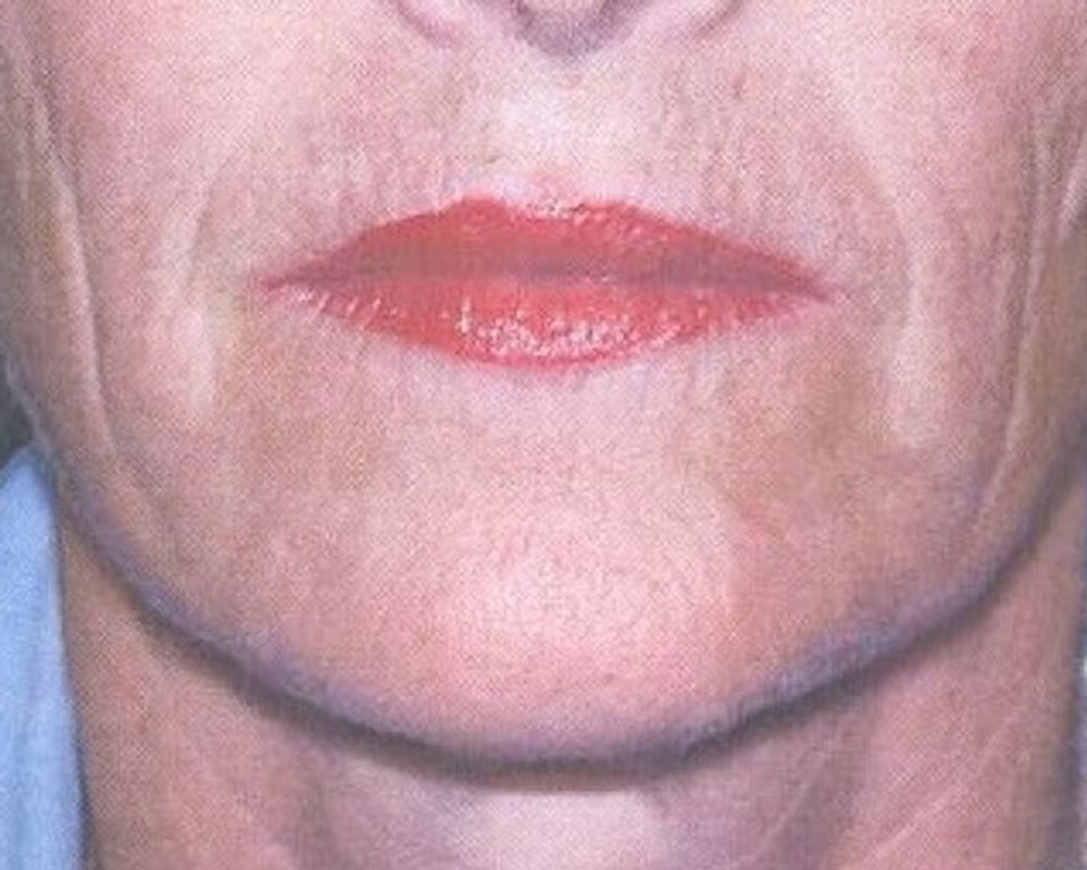 woman's mouth with botox for chin