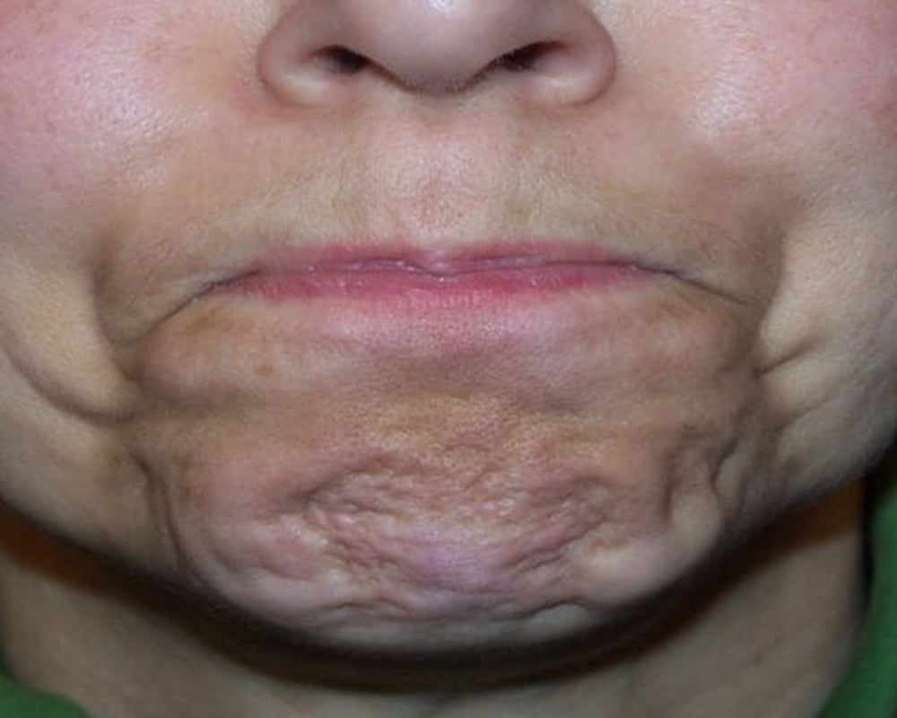 woman's mouth before filler