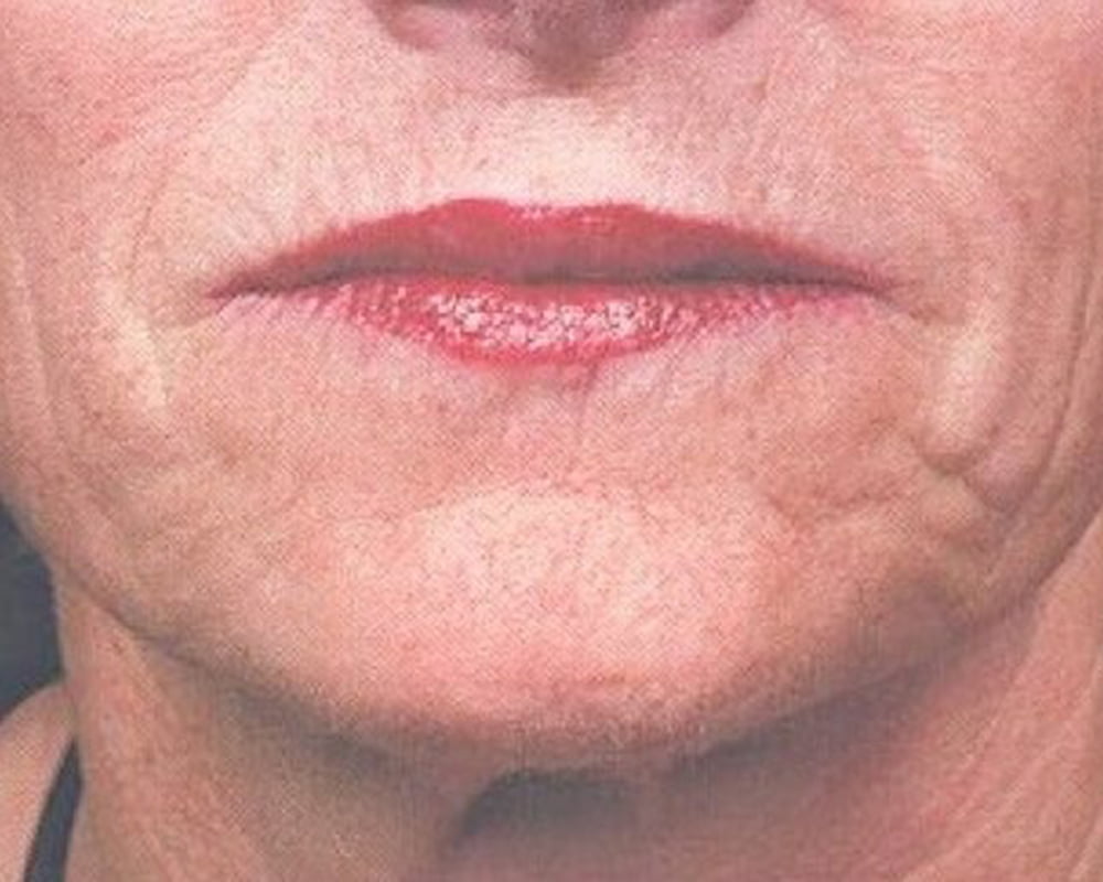 woman's mouth before botox for chin wrinkles