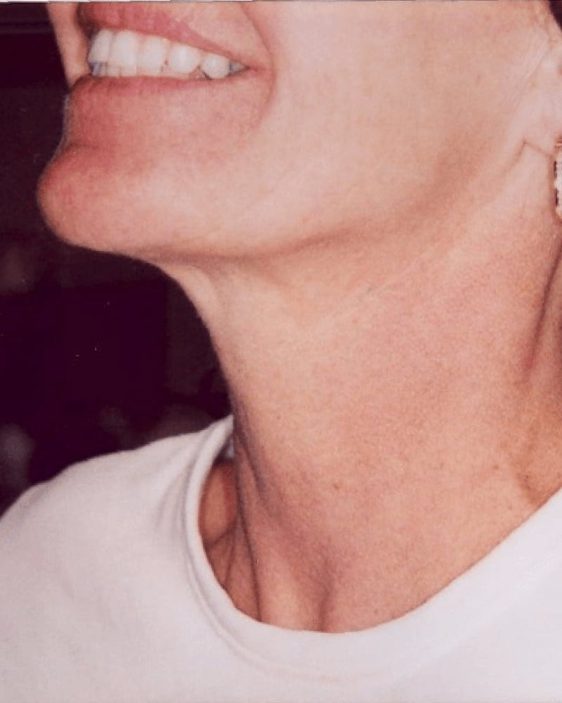 woman's neck after treatment