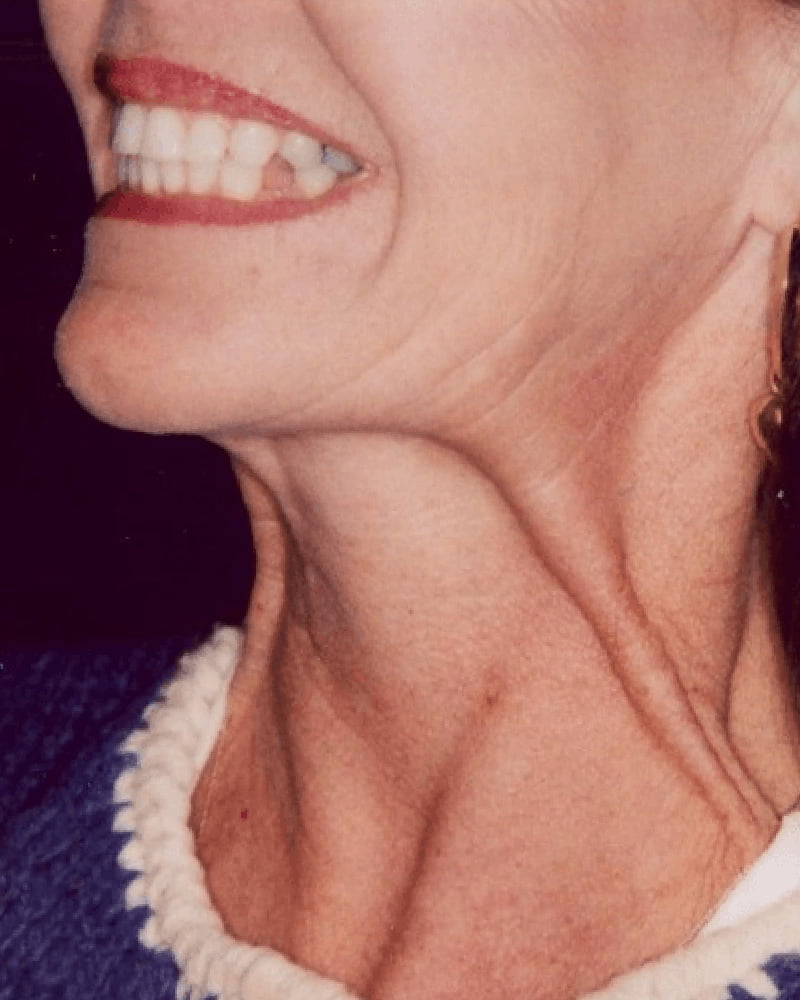 woman's neck before treatment