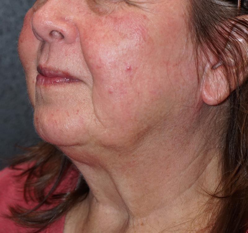 side view of woman's face before diode treatment