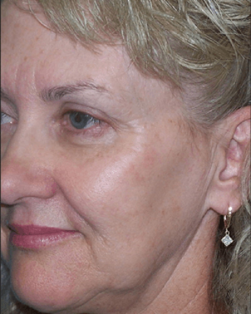 woman's face after laser treatment