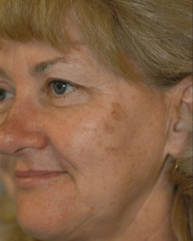 woman's face before laser treatment