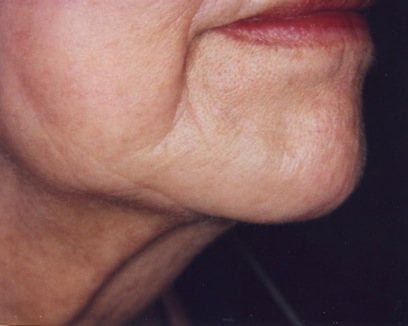 woman's chin after IPL laser treatmet