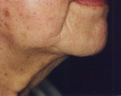 woman's chin before IPL laser treatmet