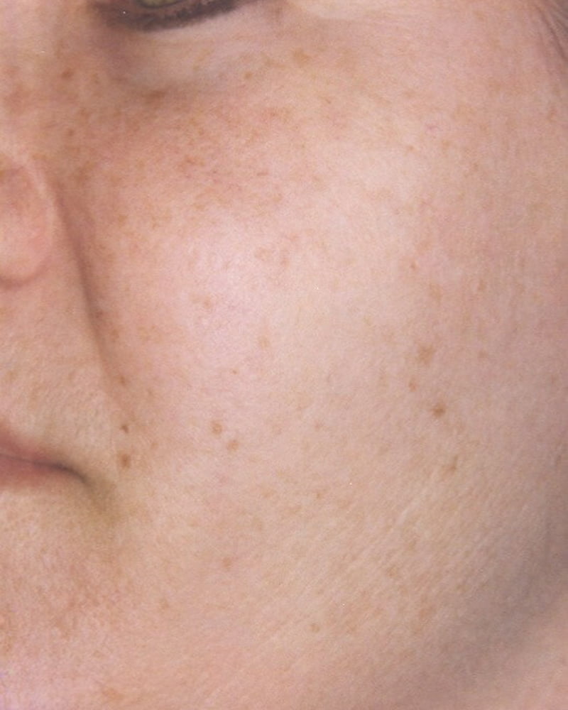 woman's face before laser treatment