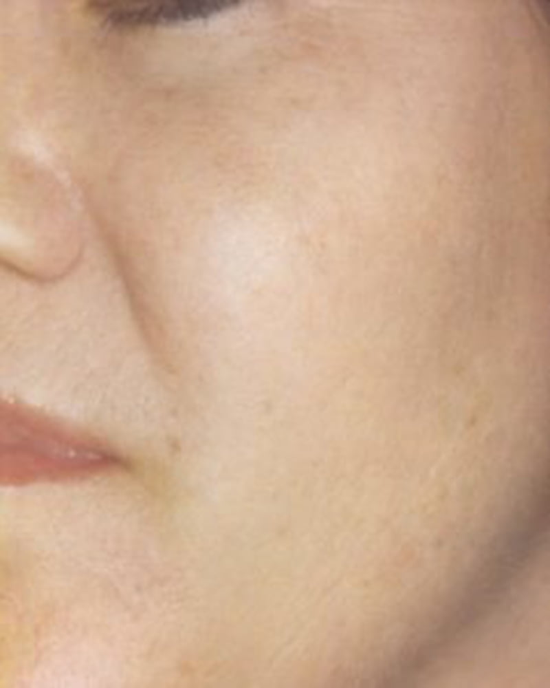 woman's face after laser skin treatment