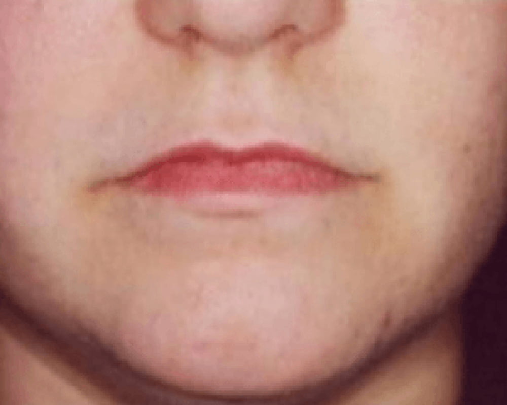 close up of face after laser hair removal