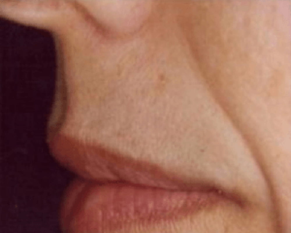 close up of lip after laser hair removal