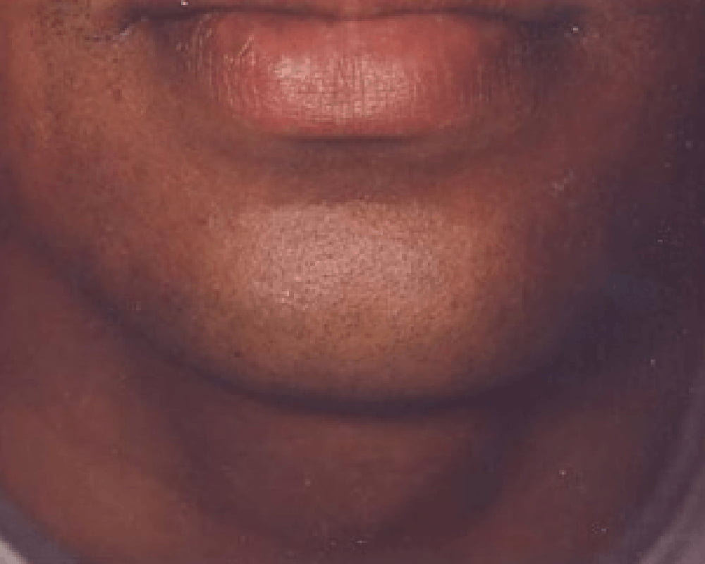 close up of chin after laser hair removal