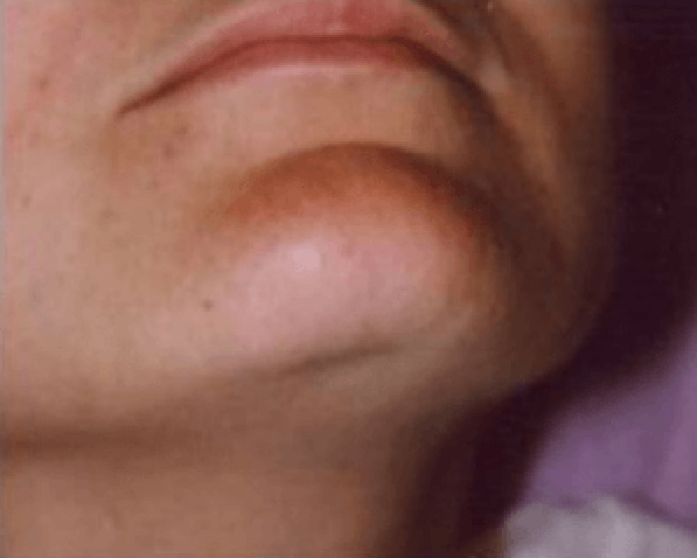 after chin laser hair removal