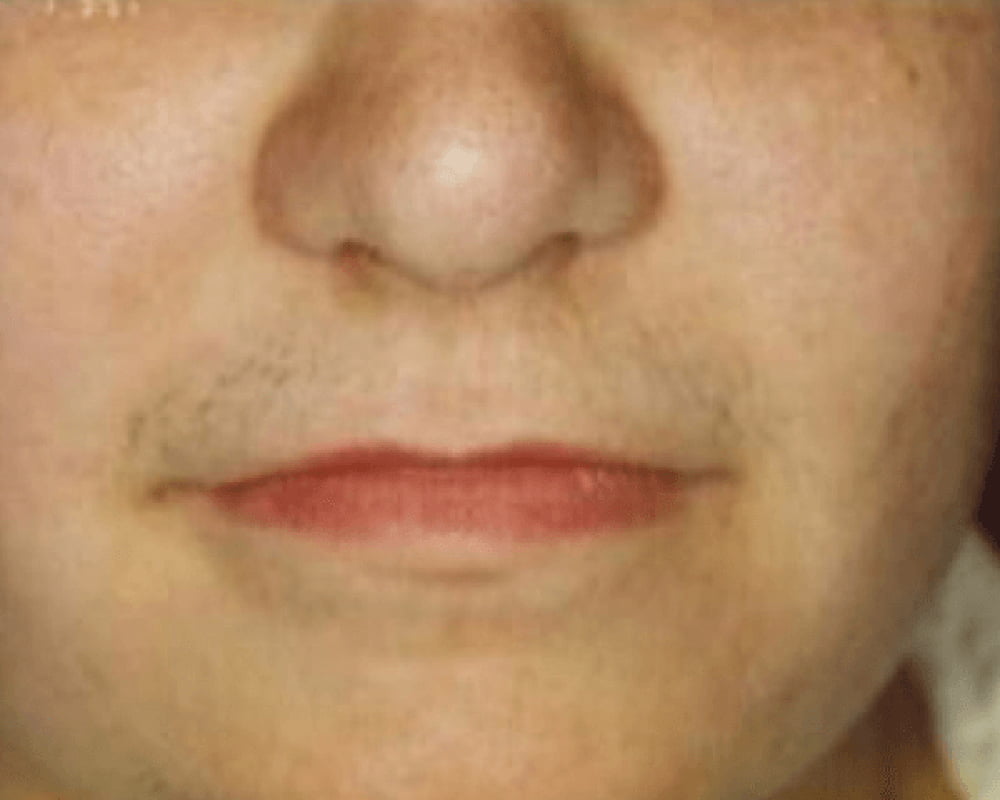 close up of face before laser hair removal