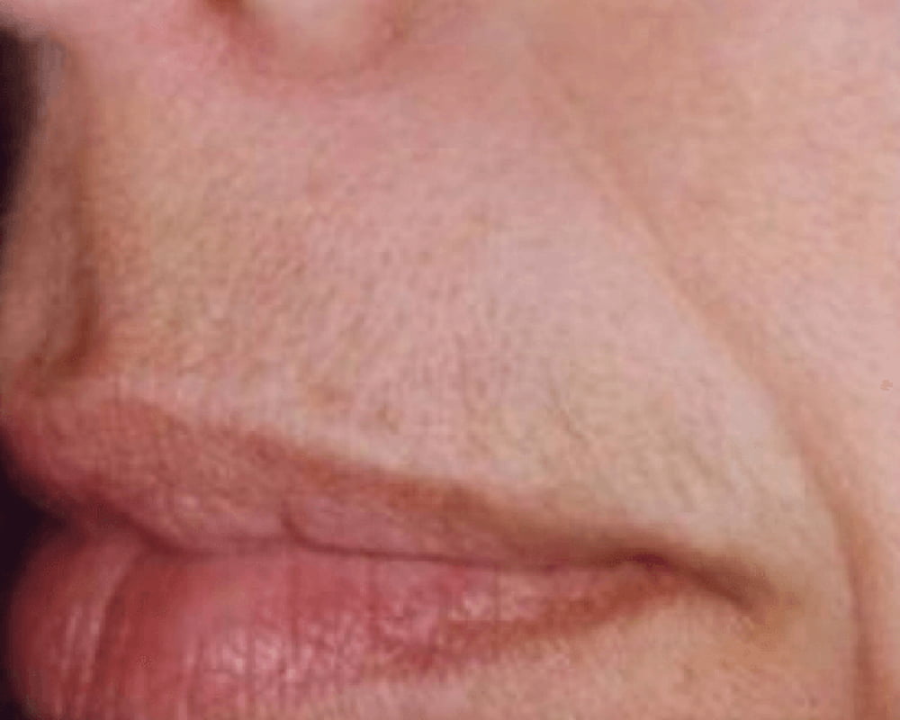 close up of lip before laser hair removal