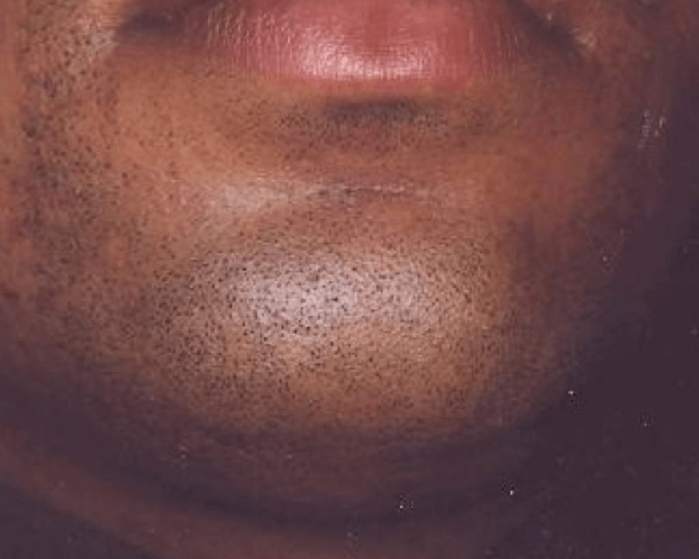 close up of chin before laser hair removal