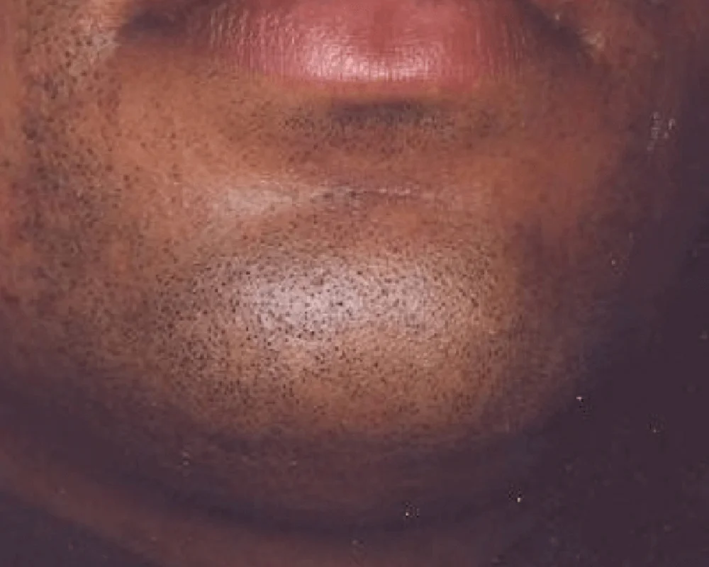 close up of chin before laser hair removal